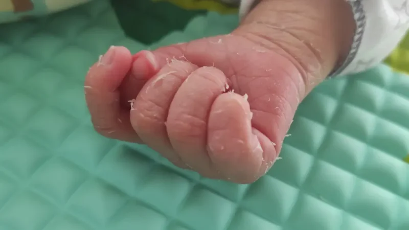 Is it normal for a newborn skin to peel