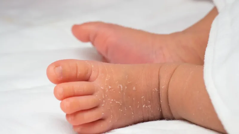 Why is My Newborn's Skin Peeling